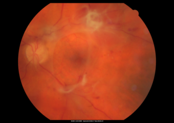 Retinal Hemorrhage: The Biomedical and The Literary