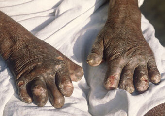 Leprosy:The Biomedical and The Literary (The Covenant of Water)