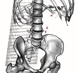 Of Pain and Profit:Montaigne’s Kidney Stones